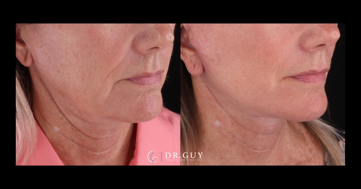 Facelift Before & After Gallery - Patient 251863 - Image 2
