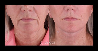 Facelift Before & After Gallery - Patient 251863 - Image 1