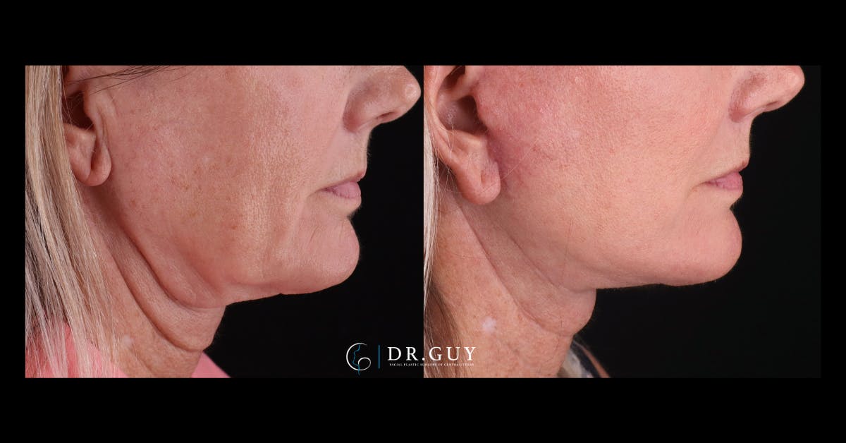 Facelift Before & After Gallery - Patient 251863 - Image 4