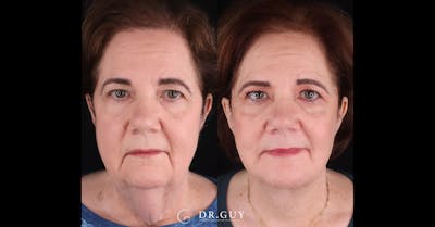 Facelift Before & After Gallery - Patient 205977 - Image 1