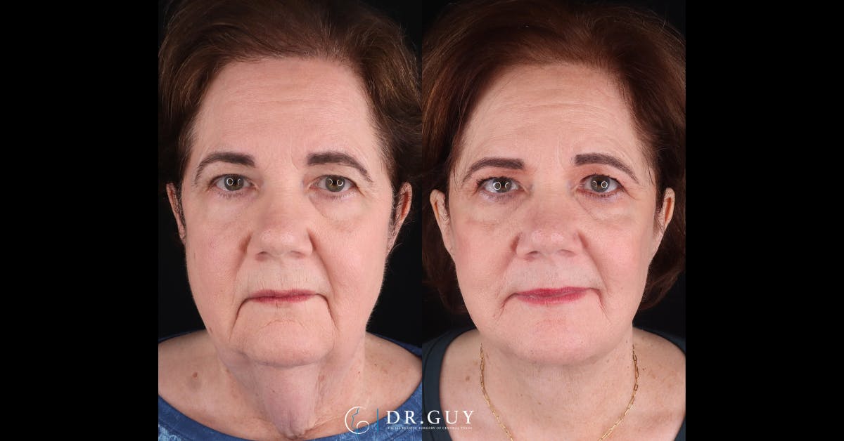 Facelift Before & After Gallery - Patient 205977 - Image 1