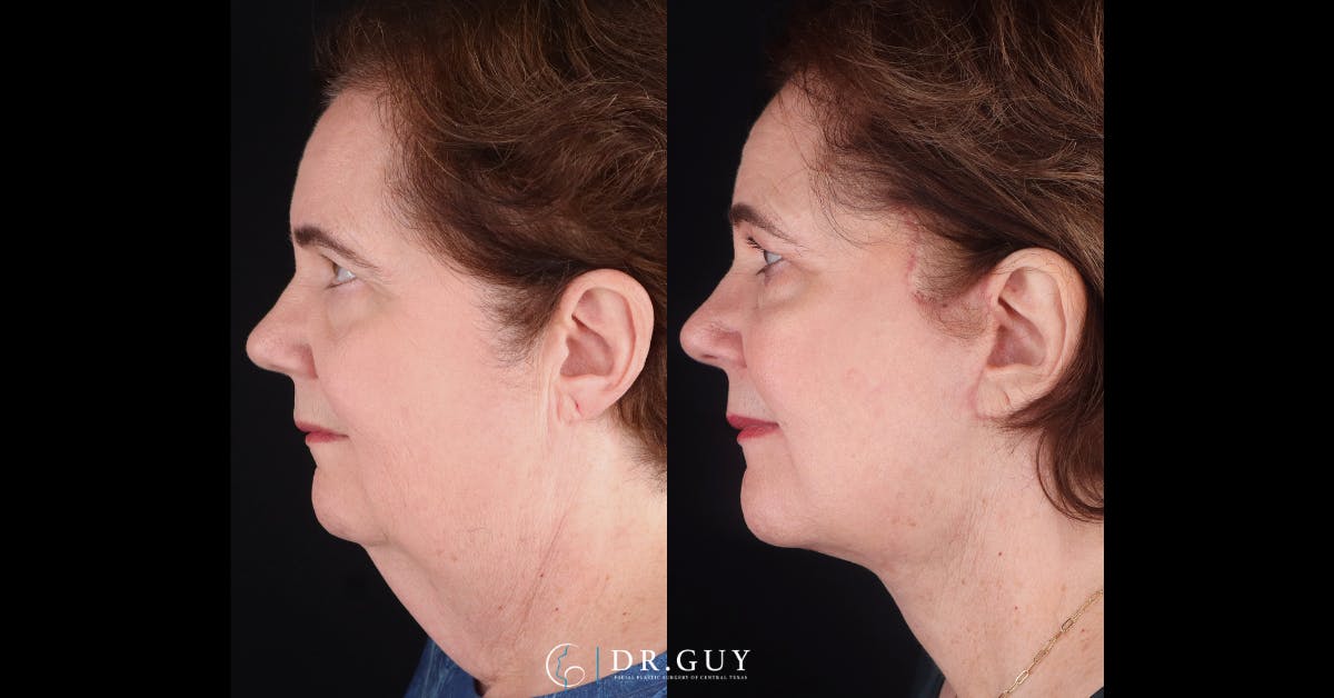 Facelift Before & After Gallery - Patient 205977 - Image 4