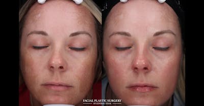 Laser Before & After Gallery - Patient 271711 - Image 1