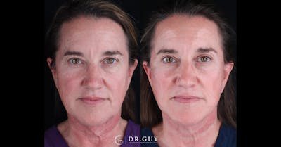 Mini Facelift Before & After Gallery - Patient 210607 - Image 1