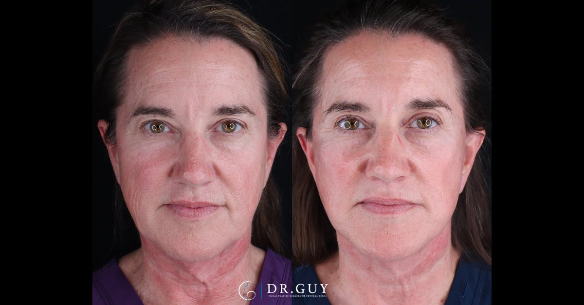 Mini Facelift Before & After Gallery - Patient 210607 - Image 1