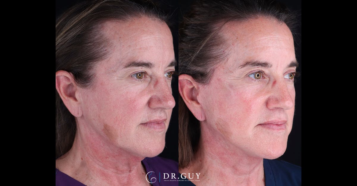 Mini Facelift Before & After Gallery - Patient 210607 - Image 2