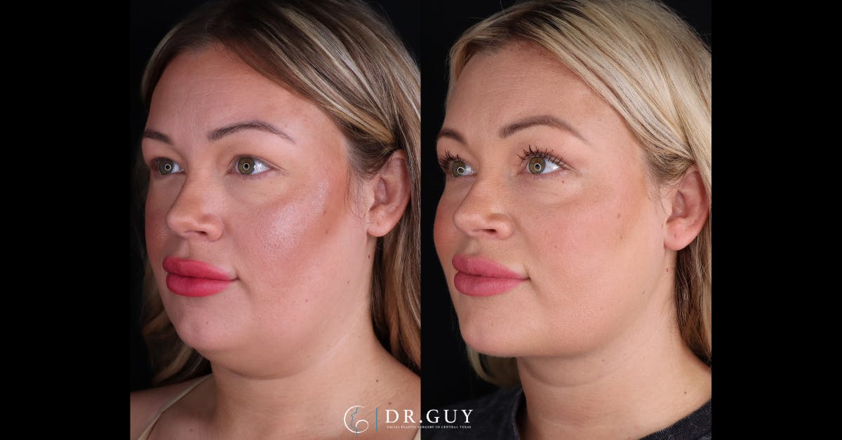 Platysmaplasty Before & After Gallery - Patient 111150 - Image 4