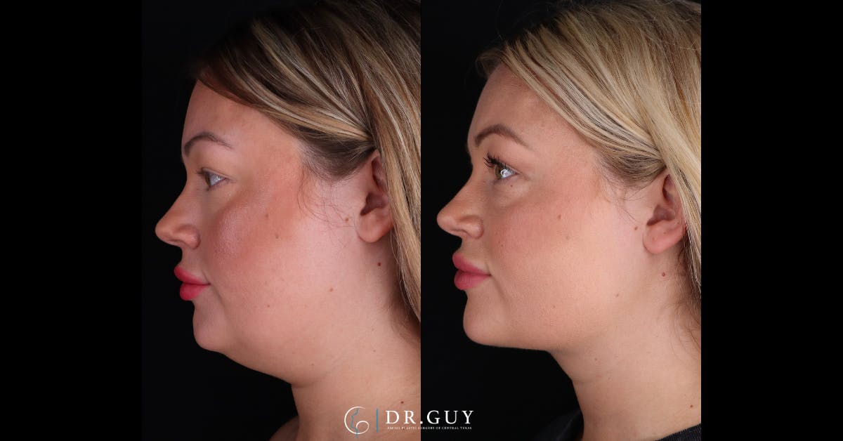 Platysmaplasty Before & After Gallery - Patient 111150 - Image 5