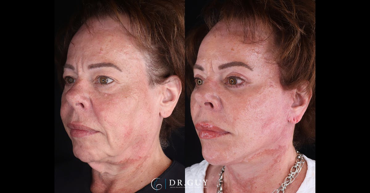 Mini Facelift Before & After Gallery - Patient 515888 - Image 3