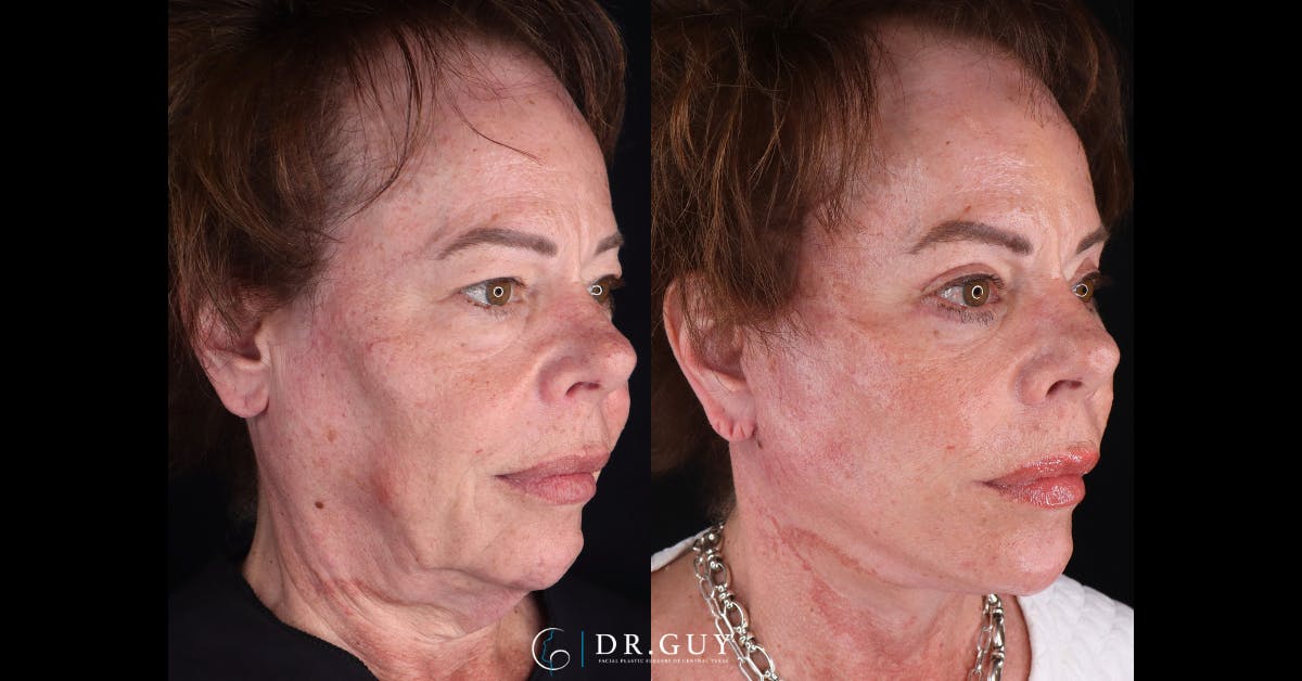 Mini Facelift Before & After Gallery - Patient 515888 - Image 2