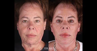 Mini Facelift Before & After Gallery - Patient 515888 - Image 1