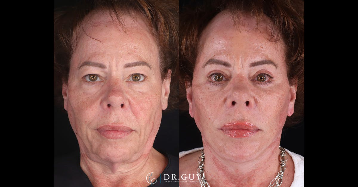 Mini Facelift Before & After Gallery - Patient 515888 - Image 1