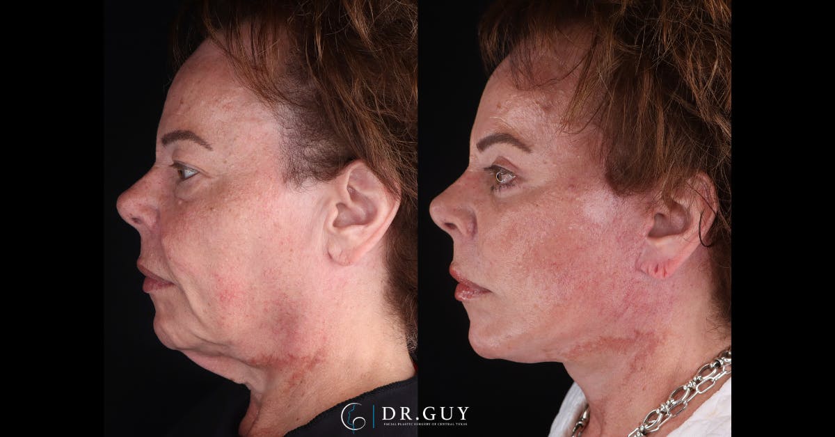 Mini Facelift Before & After Gallery - Patient 515888 - Image 4