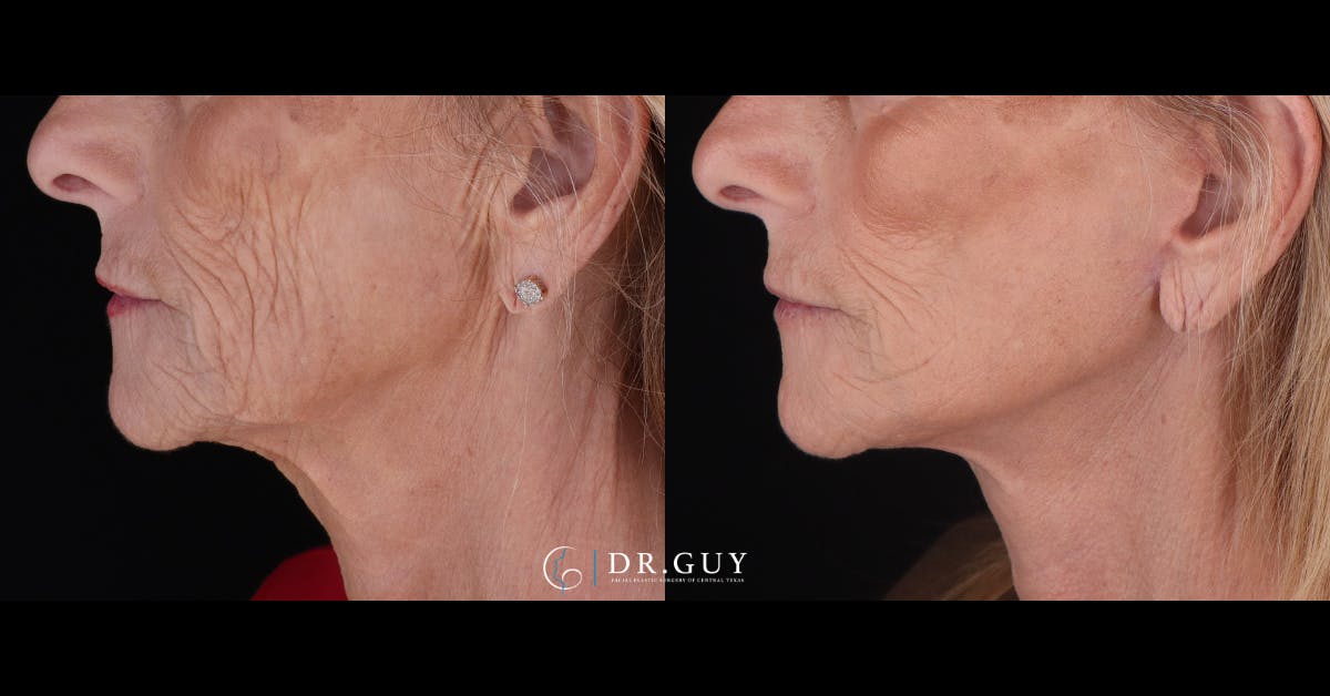 Mini Facelift Before & After Gallery - Patient 155093 - Image 5