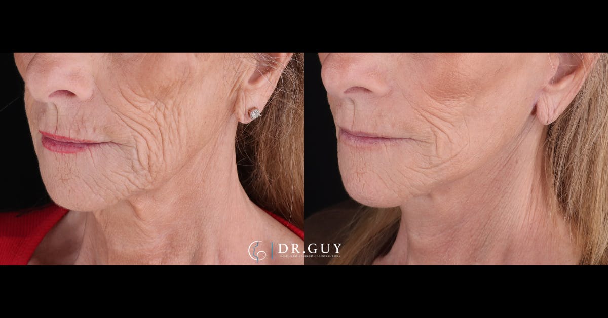Mini Facelift Before & After Gallery - Patient 155093 - Image 4