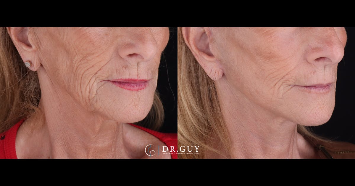 Mini Facelift Before & After Gallery - Patient 155093 - Image 2