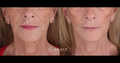 Mini Facelift Before & After Gallery - Patient 155093 - Image 1