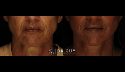 Mini Facelift Before & After Gallery - Patient 602781 - Image 1