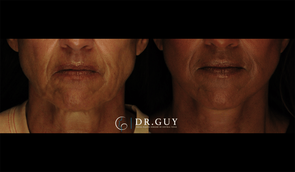 Mini Facelift Before & After Gallery - Patient 602781 - Image 1