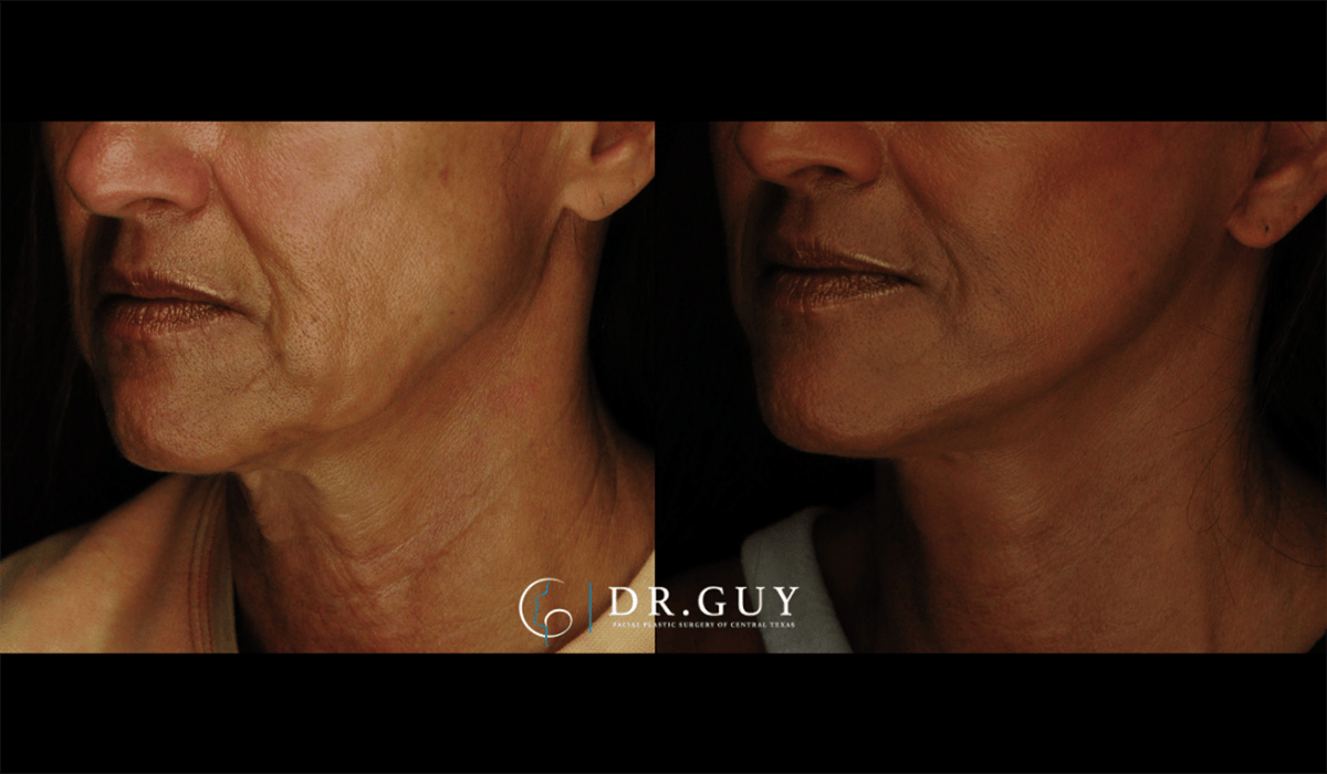 Mini Facelift Before & After Gallery - Patient 602781 - Image 2