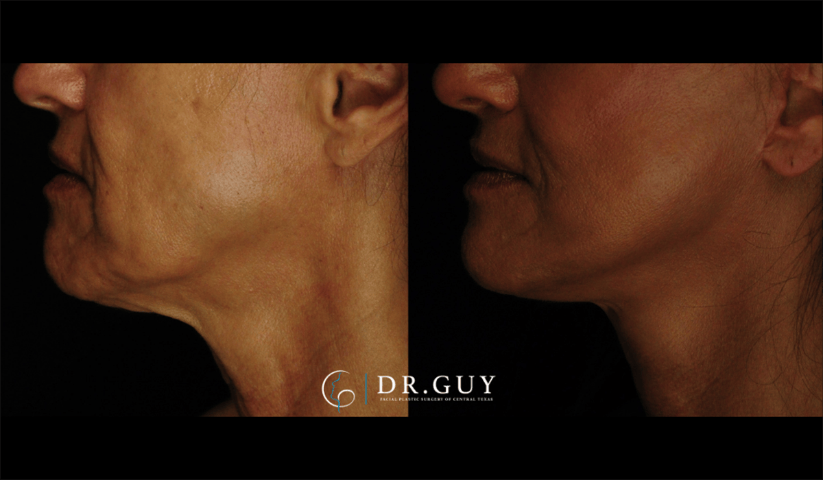 Mini Facelift Before & After Gallery - Patient 602781 - Image 3