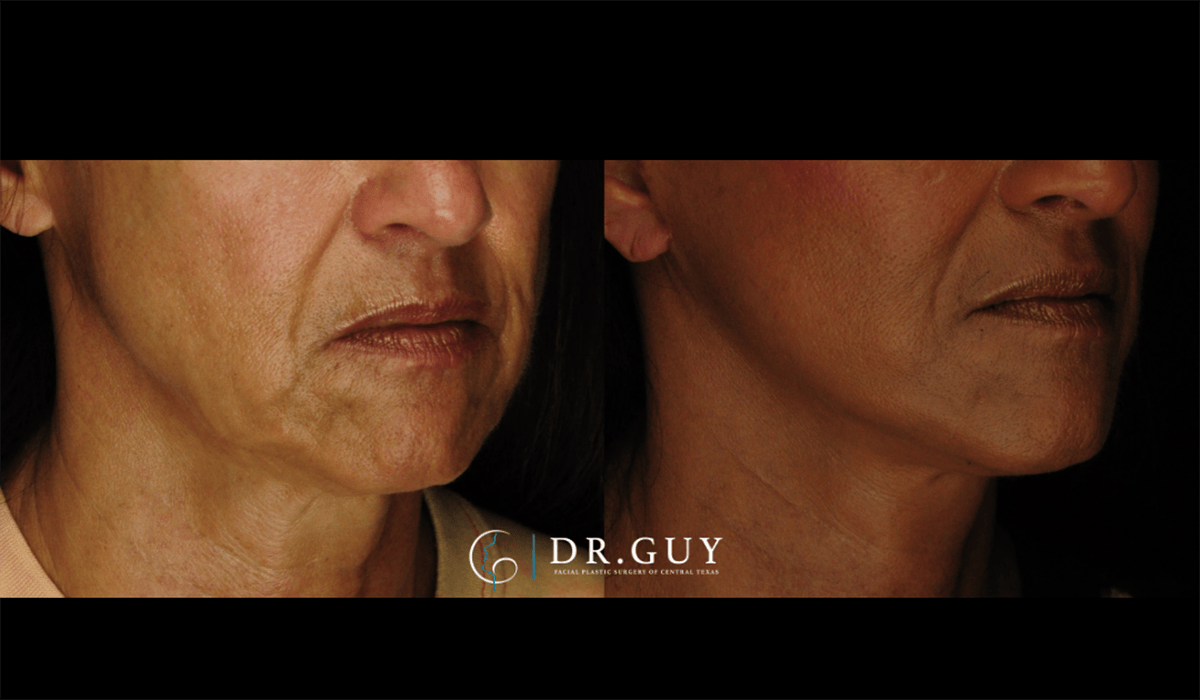 Mini Facelift Before & After Gallery - Patient 602781 - Image 4