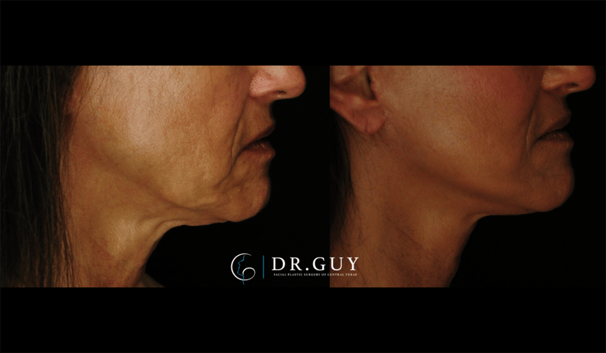 Mini Facelift Before & After Gallery - Patient 602781 - Image 5