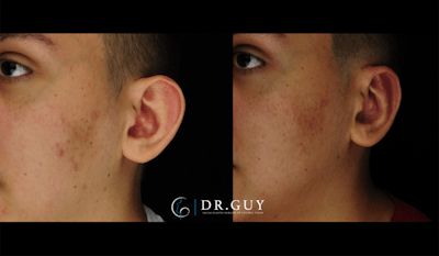 Otoplasty Before & After Gallery - Patient 410530 - Image 1