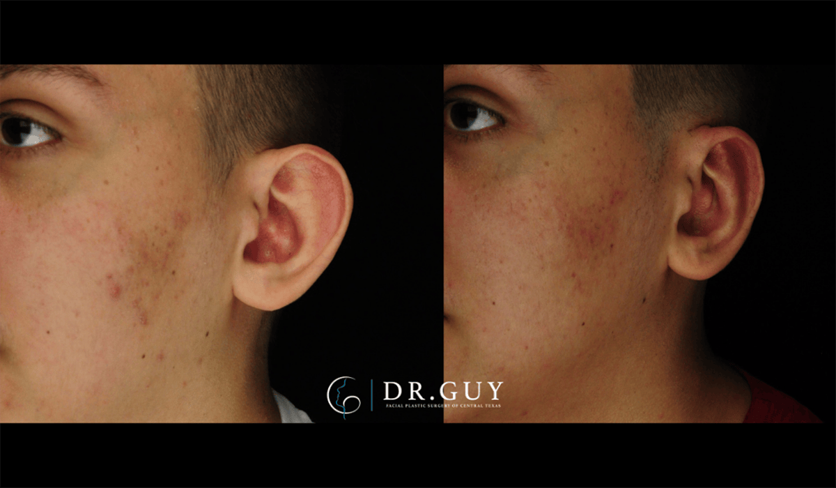 Otoplasty Before & After Gallery - Patient 410530 - Image 1