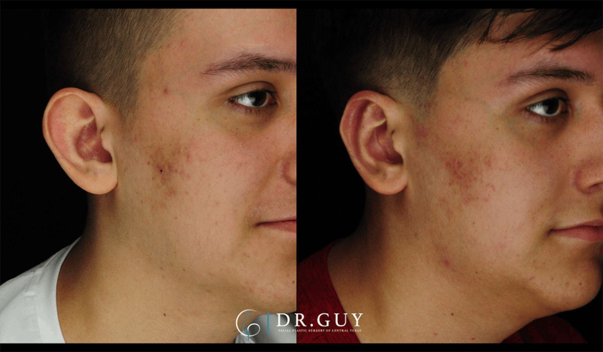 Otoplasty Before & After Gallery - Patient 410530 - Image 2