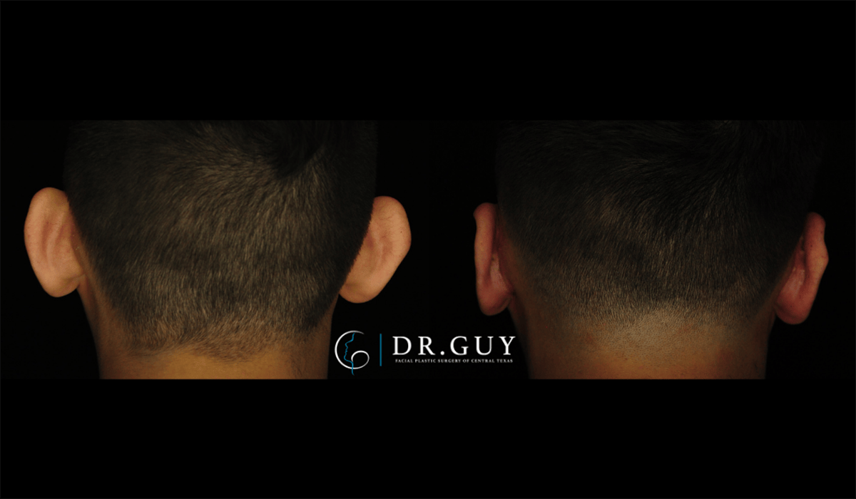 Otoplasty Before & After Gallery - Patient 410530 - Image 3