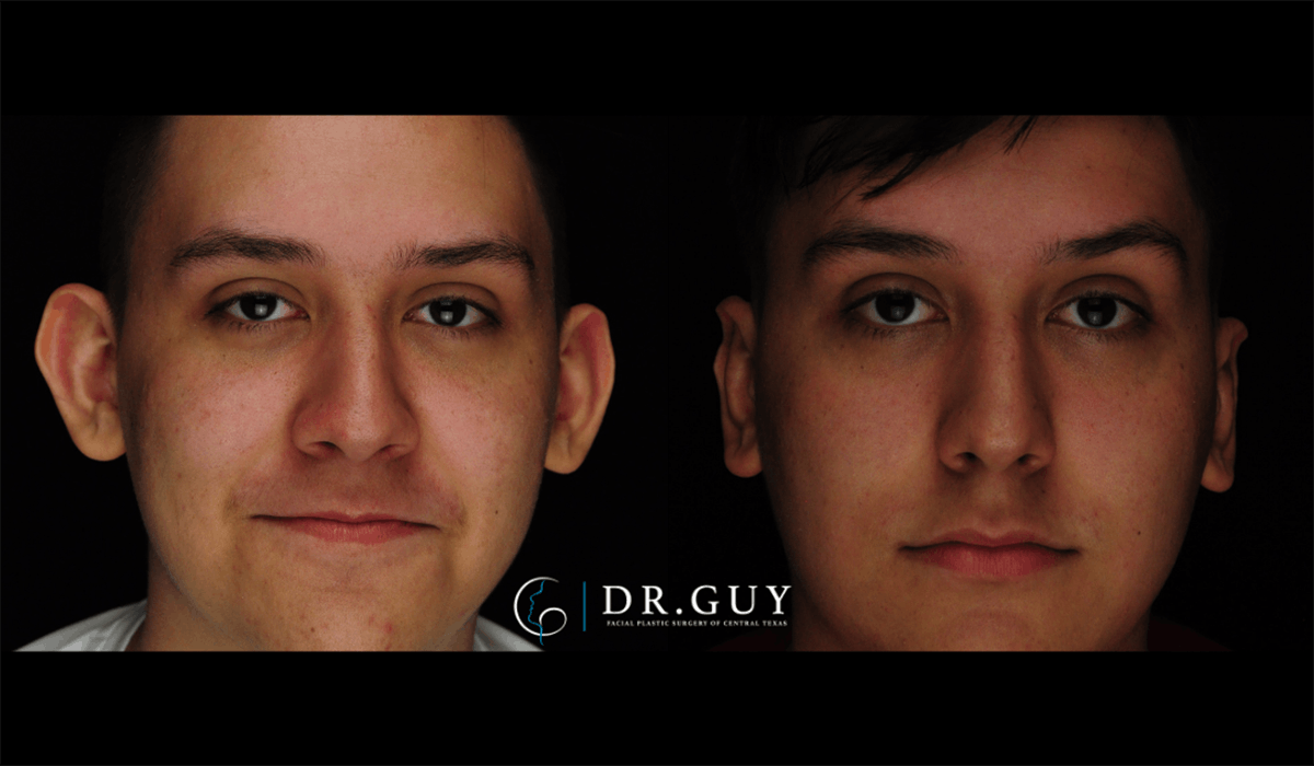 Otoplasty Before & After Gallery - Patient 410530 - Image 4