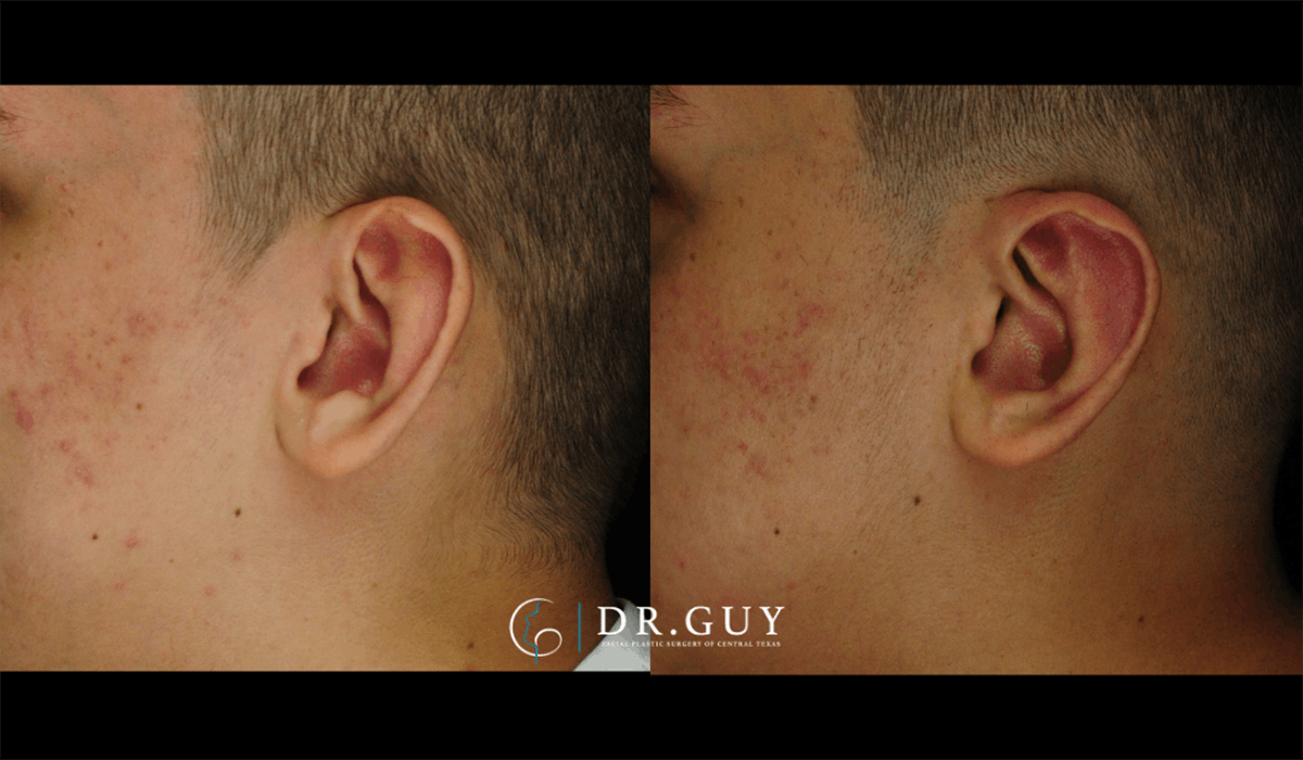 Otoplasty Before & After Gallery - Patient 410530 - Image 5