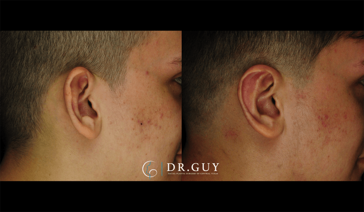 Otoplasty Before & After Gallery - Patient 410530 - Image 6